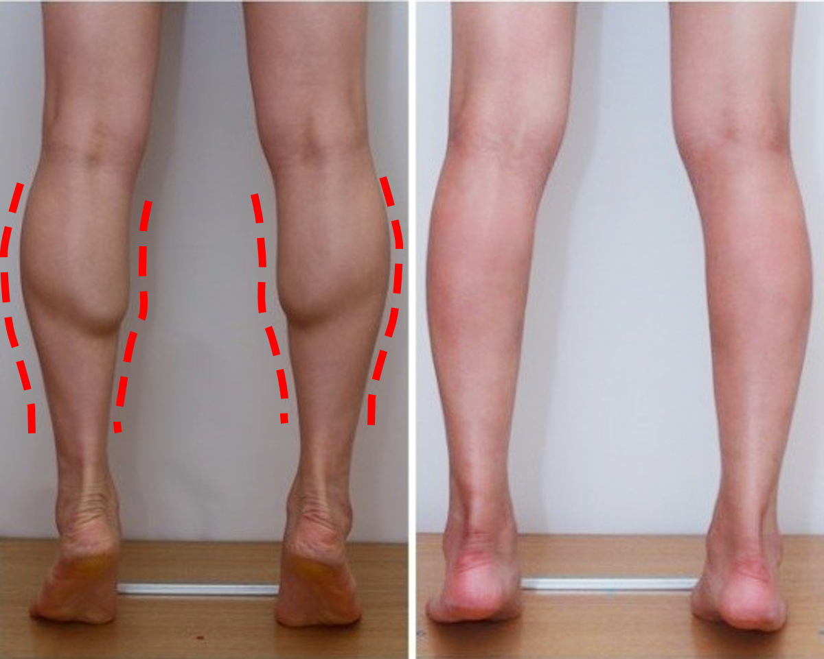 瘦小腿肌肉很簡單 | 這樣做肥腿超快小1號! / 很多人覺得瘦小腿、大腿很難，其實是因為不了解自己腿型，不能對症下藥，而導致瘦腿困難重重... 其實腿型問題主要分為兩大類：水腫型、肌肉型
